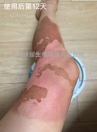 全球首创——II度烧烫伤诊疗不疼痛，不起泡，不溃疡，不感染，不留疤