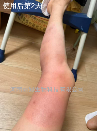 全球首创——II度烧烫伤诊疗不疼痛，不起泡，不溃疡，不感染，不留疤