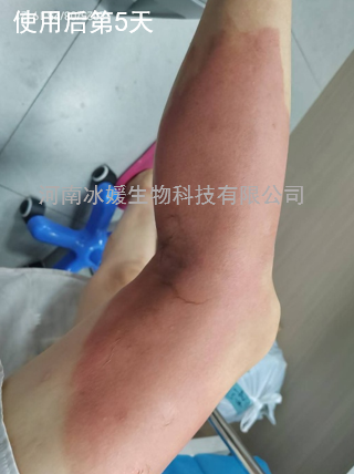 全球首创——II度烧烫伤诊疗不疼痛，不起泡，不溃疡，不感染，不留疤