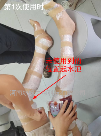 全球首创——II度烧烫伤诊疗不疼痛，不起泡，不溃疡，不感染，不留疤