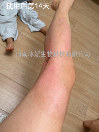 全球首创——II度烧烫伤诊疗不疼痛，不起泡，不溃疡，不感染，不留疤