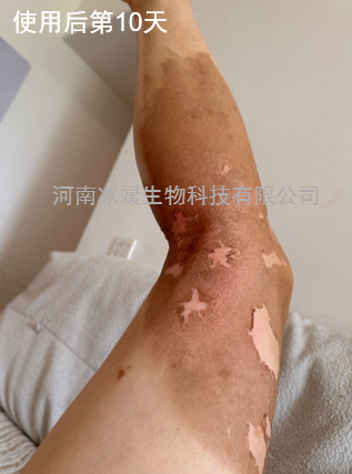 全球首创——II度烧烫伤诊疗不疼痛，不起泡，不溃疡，不感染，不留疤